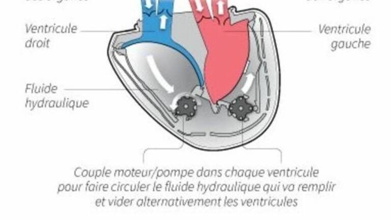Le Coeur Artificiel Carmat A Eu Un Defaut De Pilotage De Moteurs