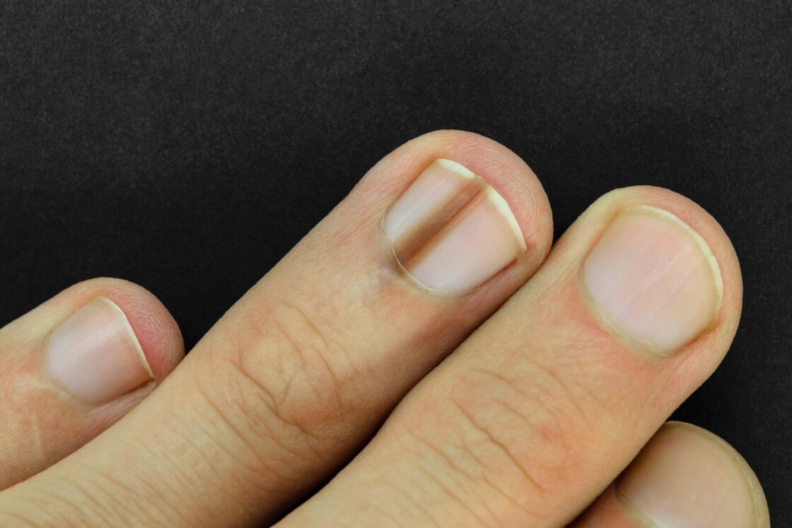 What Do Dark Marks On Your Nails Mean